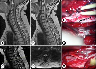 Case Report: Idiopathic Spinal Cord Herniation: An Overlooked and Frequently Misdiagnosed Entity